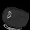 SPORK, NICO - 22.03.1976 - 02.08.2022 - CT obere Extremität - 17:59:38